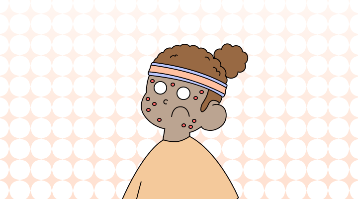 ニキビ英語で(Acne, Pimple, Zit差異と意味)