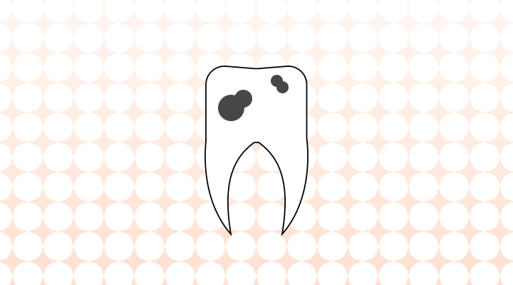 虫歯英語で(cavity, tooth decay,dental carries及び連関表現)